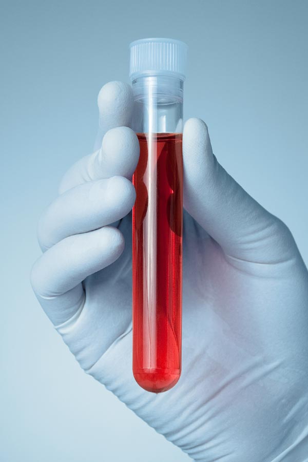 Autoimmune-Treatment Close up of a gloved hand holding a vial of red liquid, representing Nonkulie Dladla, M.D.'s comprehensive autoimmune disorder treatment in Manhattan.