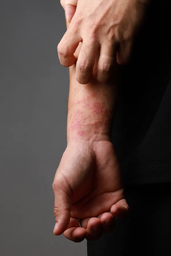Eczema-Treatment One hand scratches an area irritated by eczema on the other wrist. Get treatment for eczema from Nonkulie Dladla, M.D. in Manhattan.