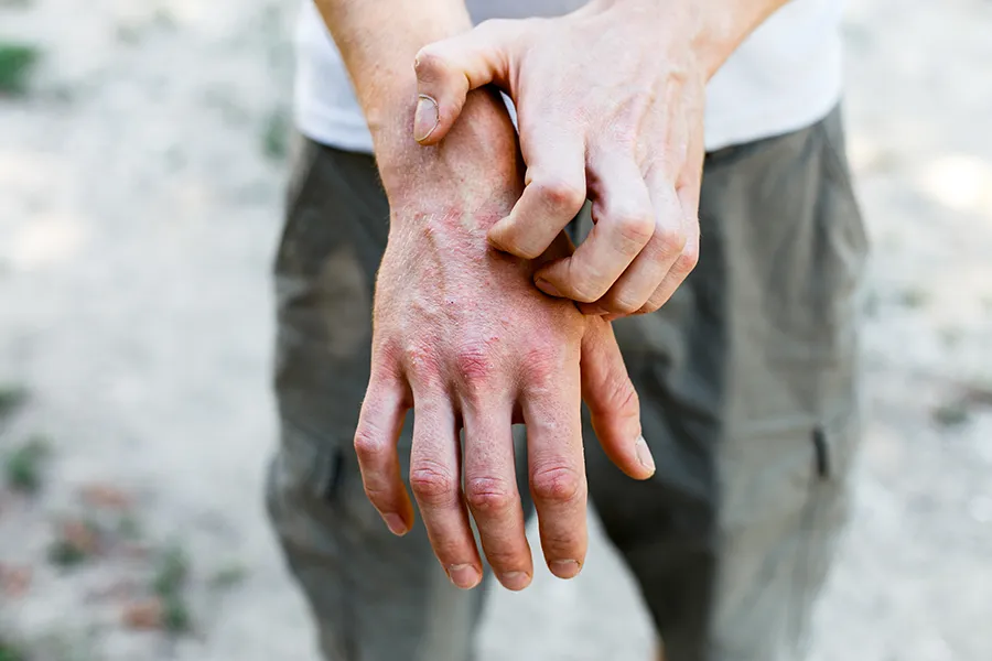 Psoriasis-Clinic Close-up of a man scratching his hands while experiencing Psoriasis. Get care for Psoriasis from Nonkulie Dladla, M.D. in Manhattan.