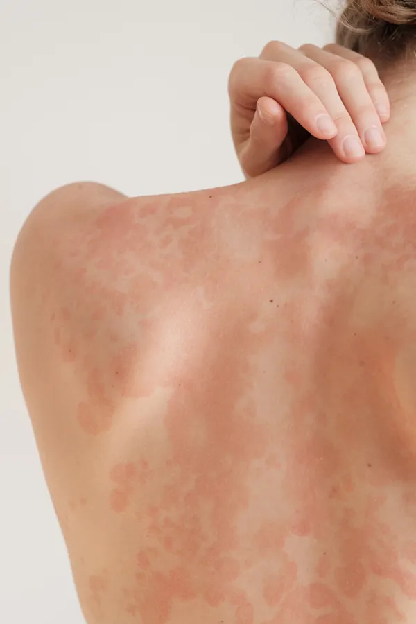 Psoriasis-Treatment The back and shoulder of a woman experiencing Psoriasis. Get treatment for Psoriasis from Nonkulie Dladla, M.D. in Manhattan.