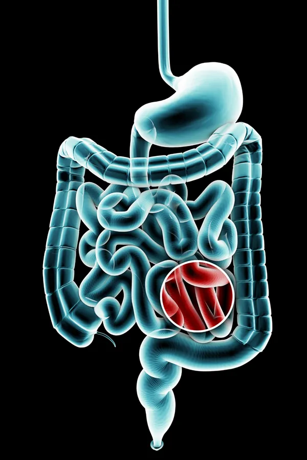 Ulcerative-Colitis-Treatment 3D illustration of the digestive system in blue tones, with an area of discomfort in red tones. Get treatment for Ulcerative Colitis from Nonkulie Dladla, M.D. in Manhattan.